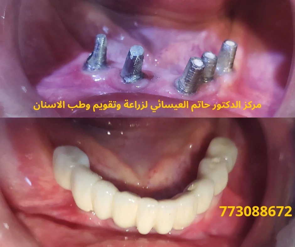 زراعة الاسنان في عدن اليمن.. افضل دكتور زراعة اسنان في عدن اليمن