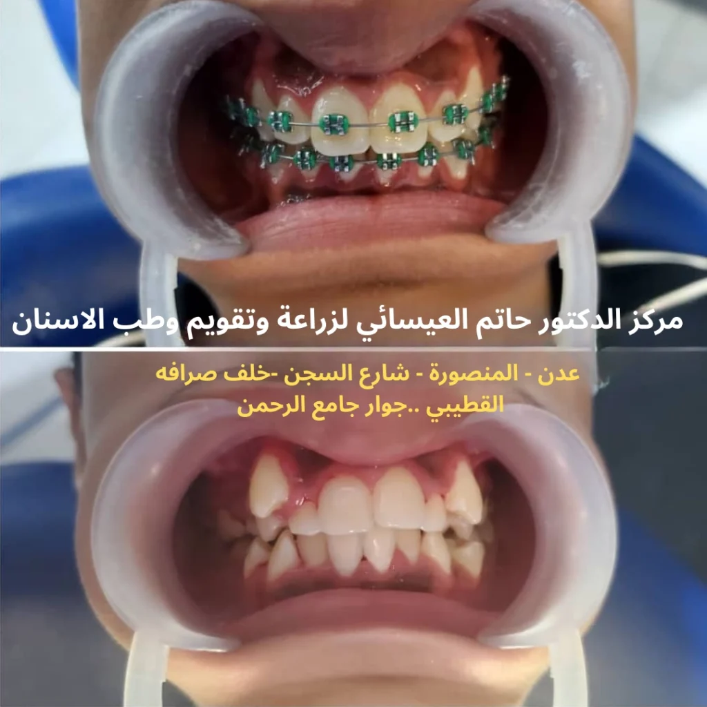 علاج تزاحم الاسنان بواسطه تقويم الاسنان قبل وبعد في عدن