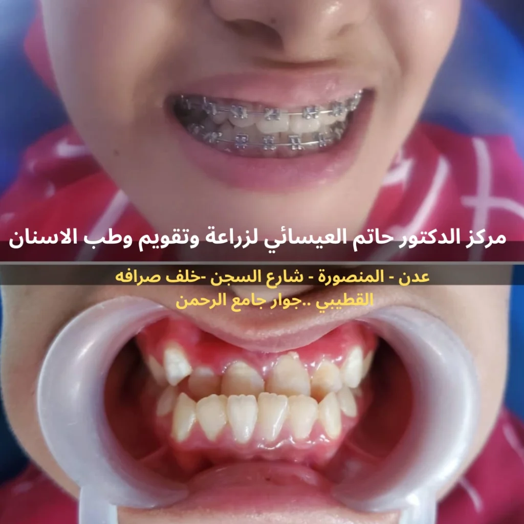 علاج بروز اسنان الفك السفلي في عدن تقويم اسنان