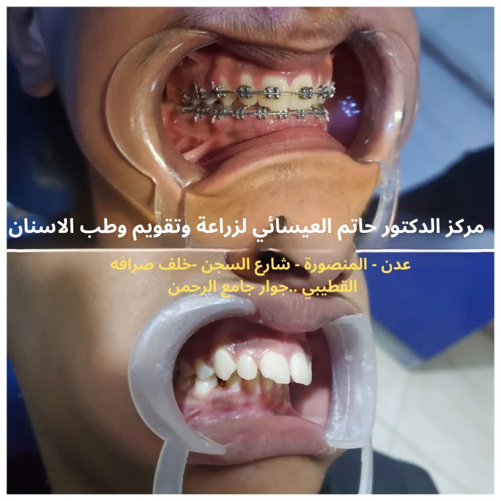 علاج بروز الاسنان بواسطه تقويم الاسنان قبل وبعد في عدن